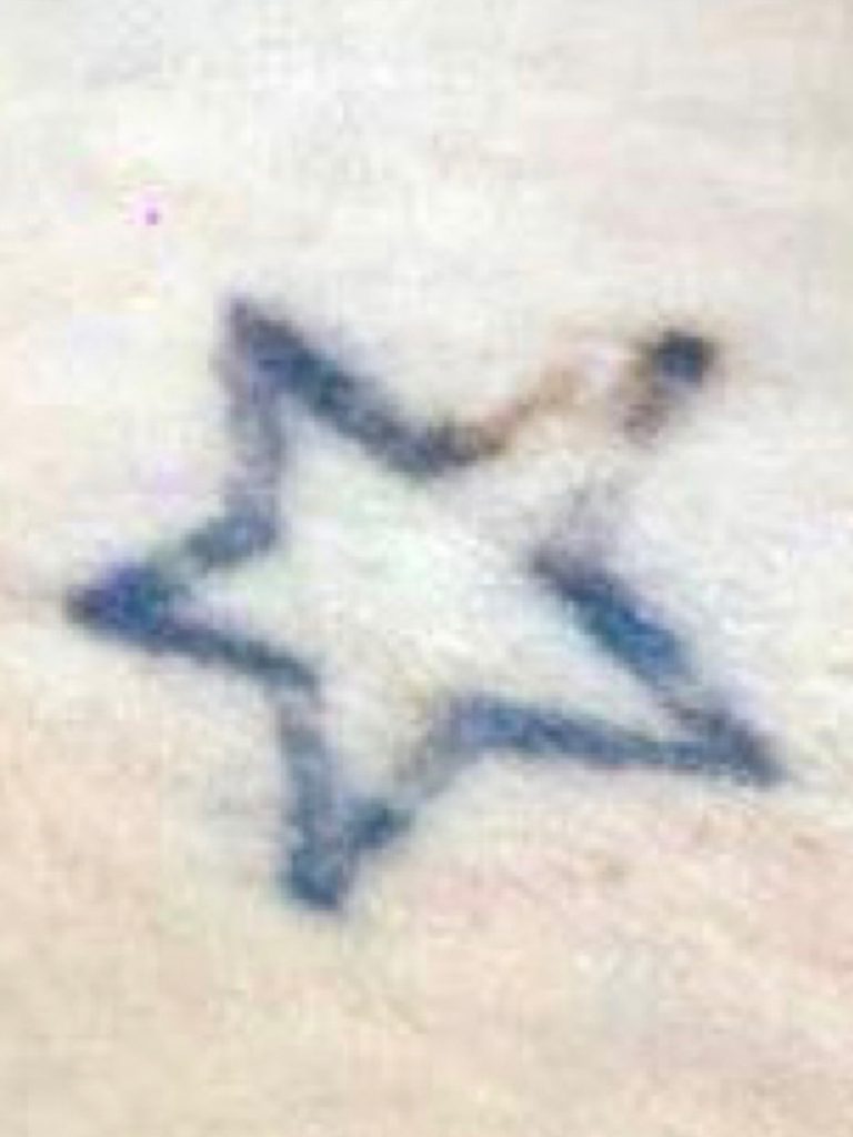 A clients star tattoo before having laser tattoo removal
