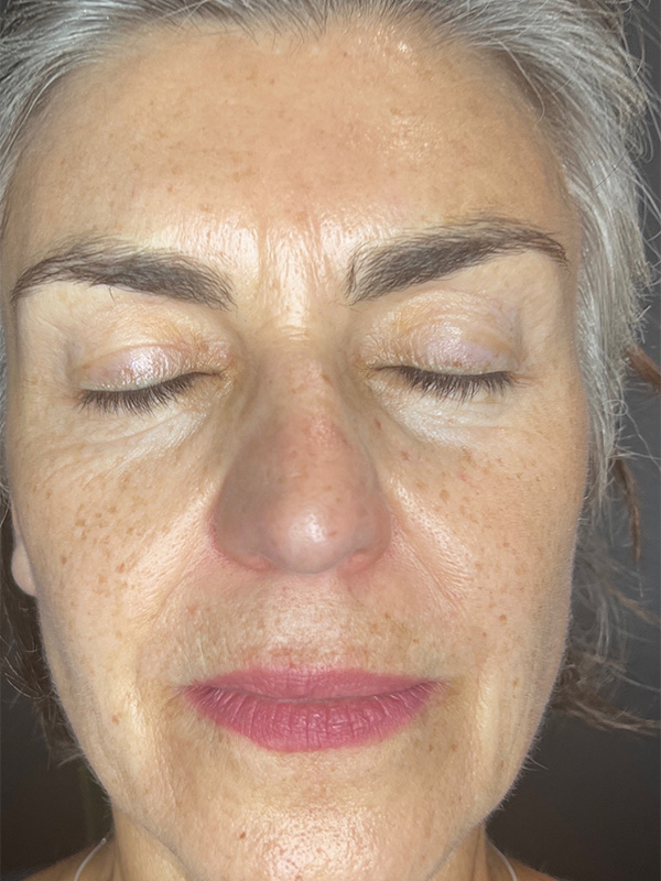 radiofrequency before and after pictures on a womans face