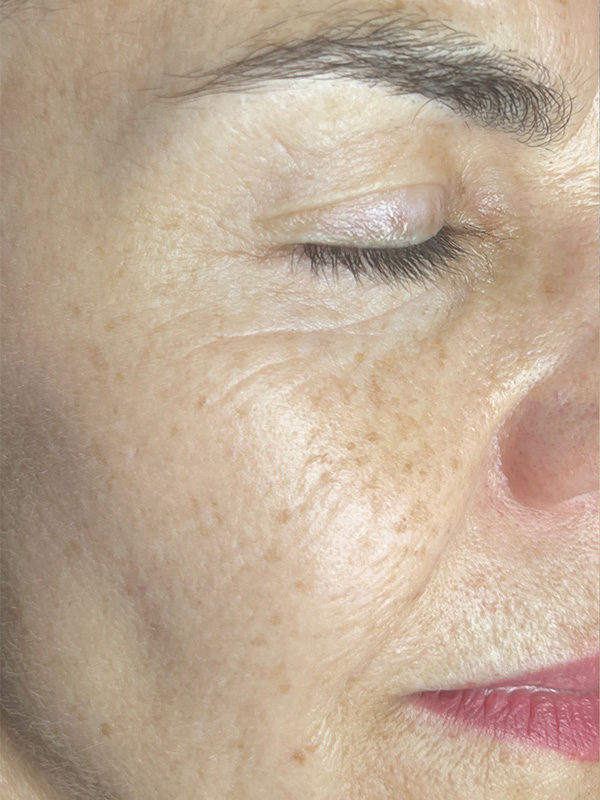 radiofrequency before and after pictures on a womans cheek