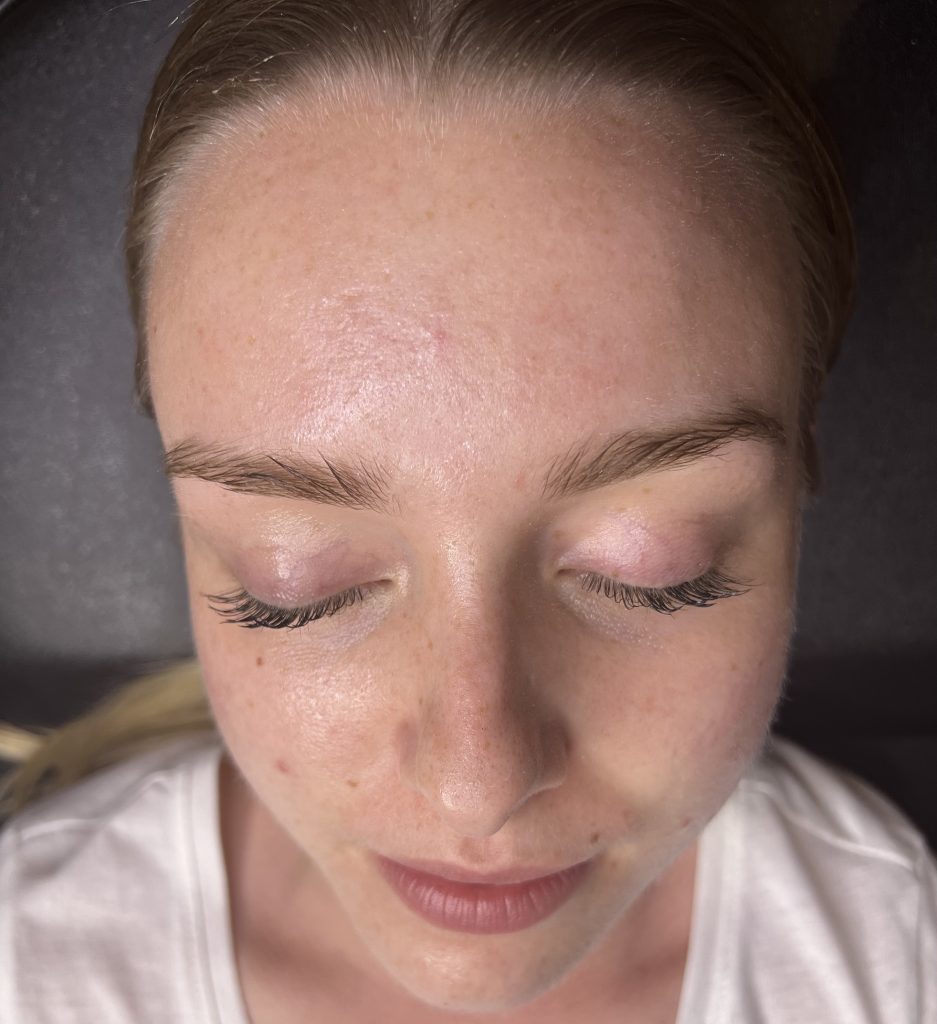 Carbon laser facial before and after pictures
