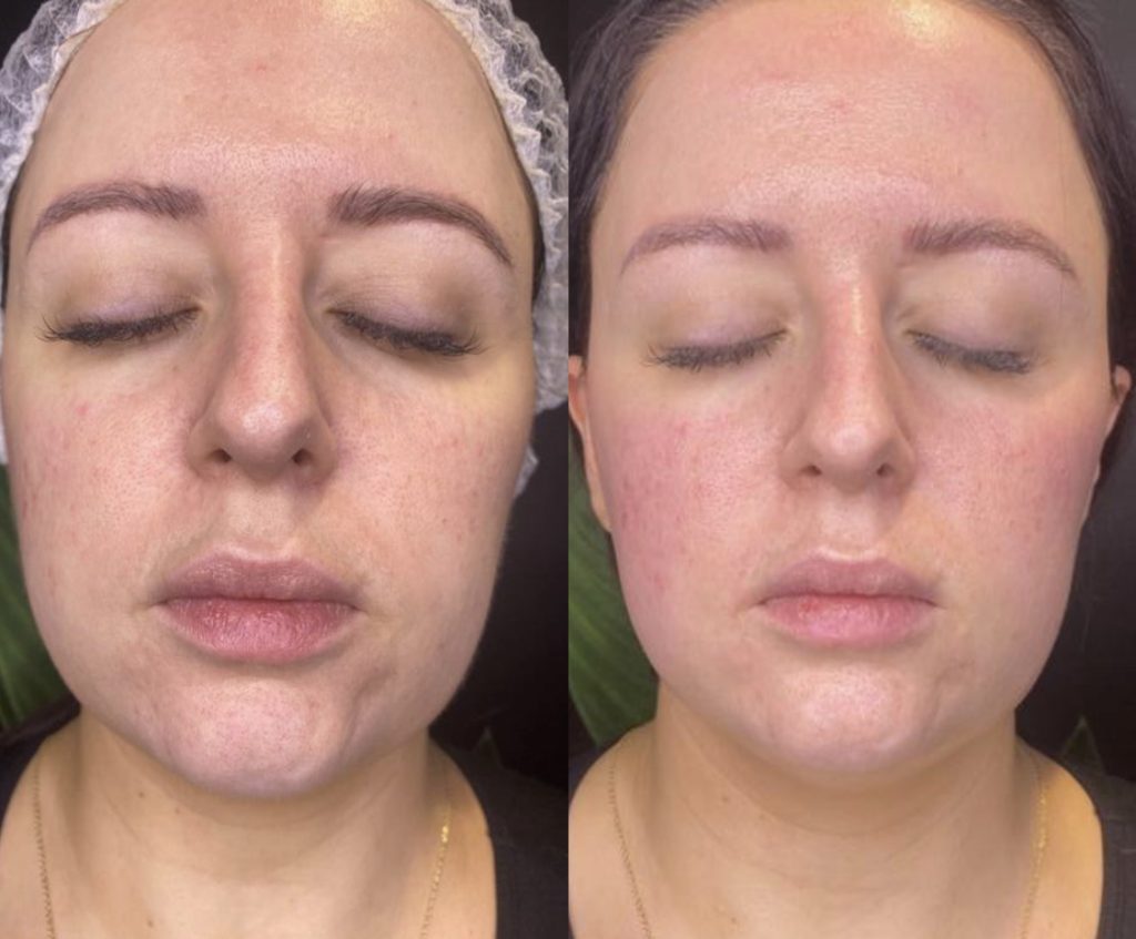 A before and after picture of a woman who has had a hydrating facial treatment