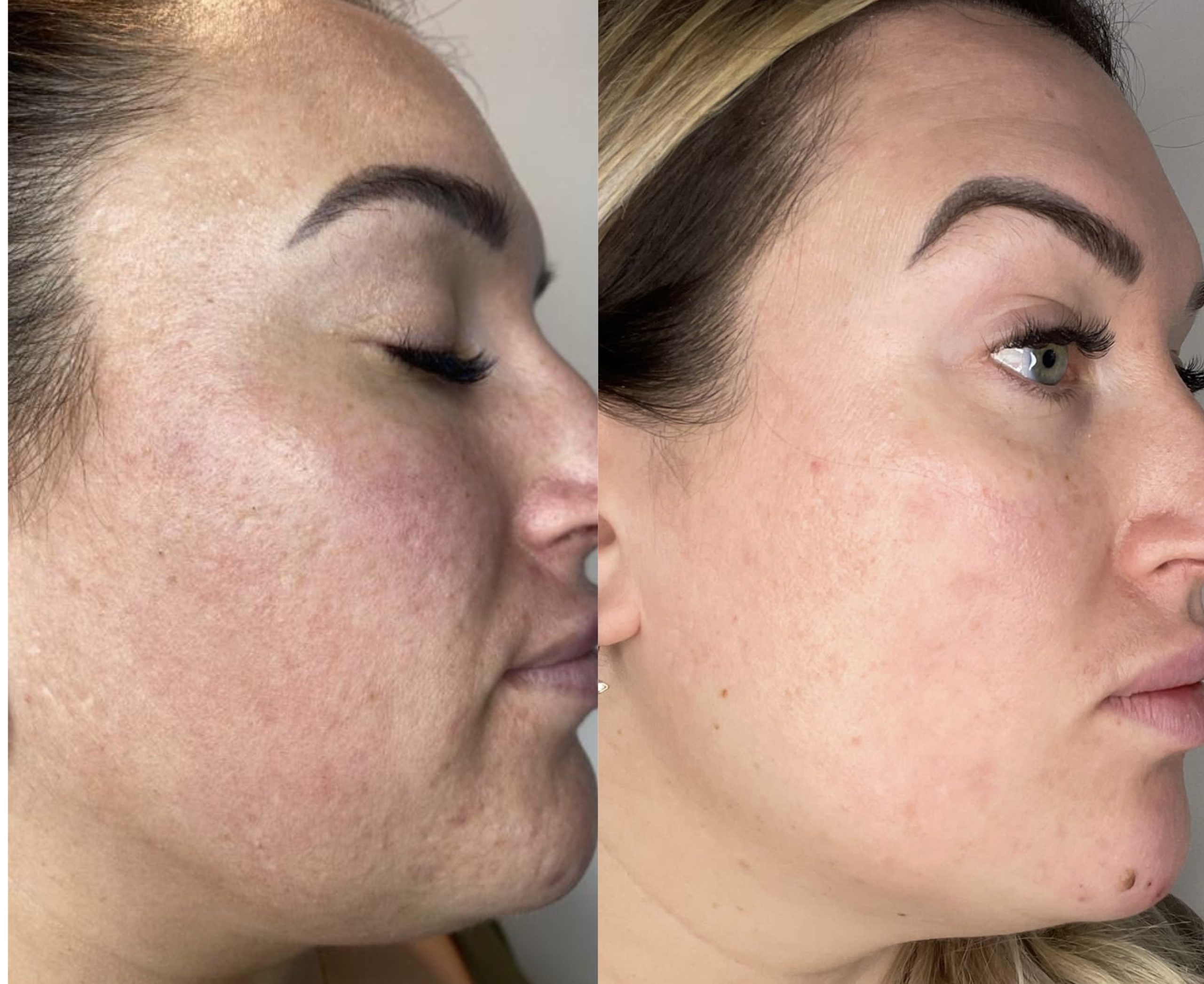 CO2 Laser Resurfacing - The Norwich Face & Body Clinic