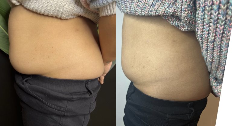 cryolipolysis fat freezing before and after