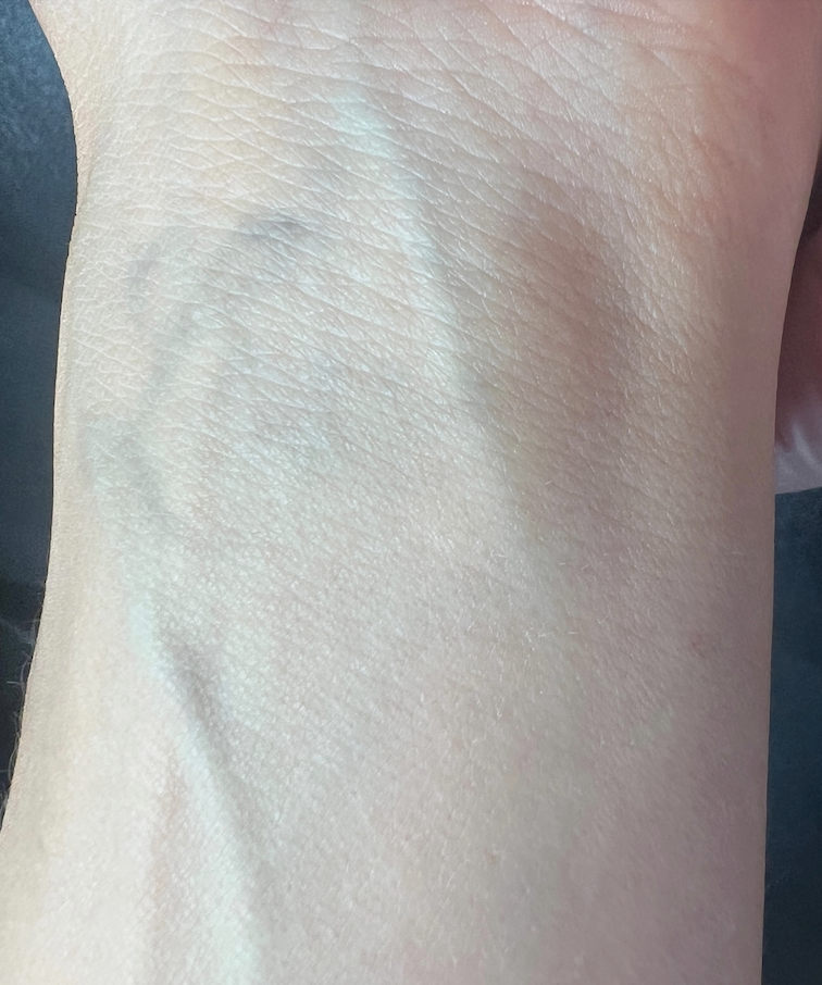 Laser tattoo removal on the wrist after photo