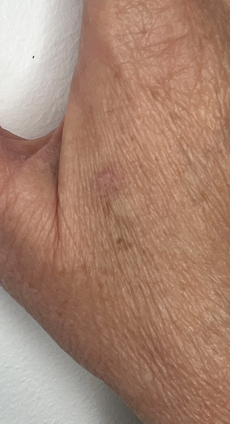 Skin tag removal on the hand after treatment