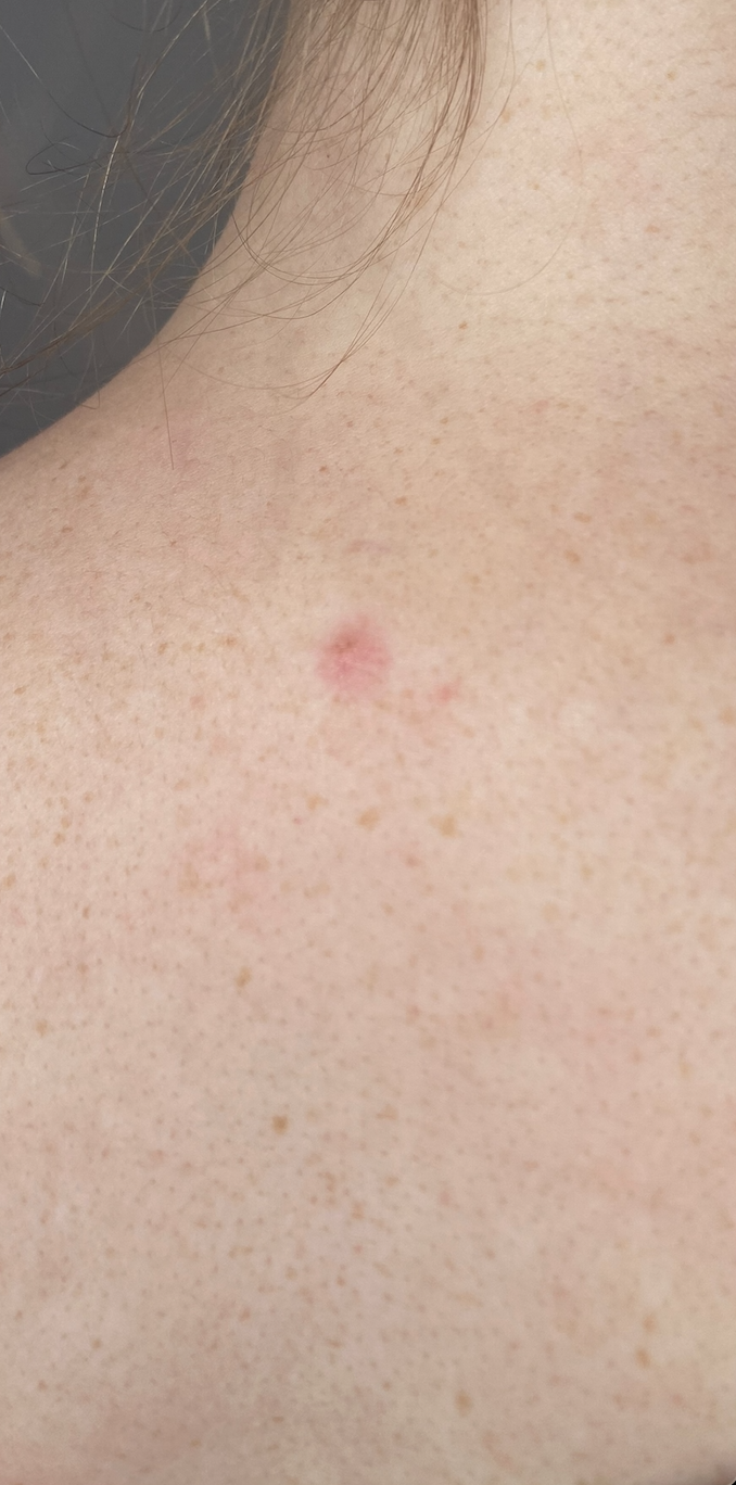Skin tag removal on the back, after treatment