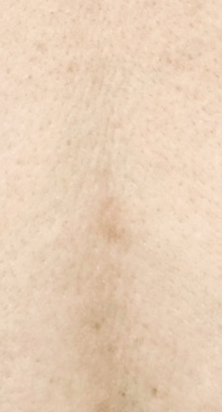 Mole removal after treatment