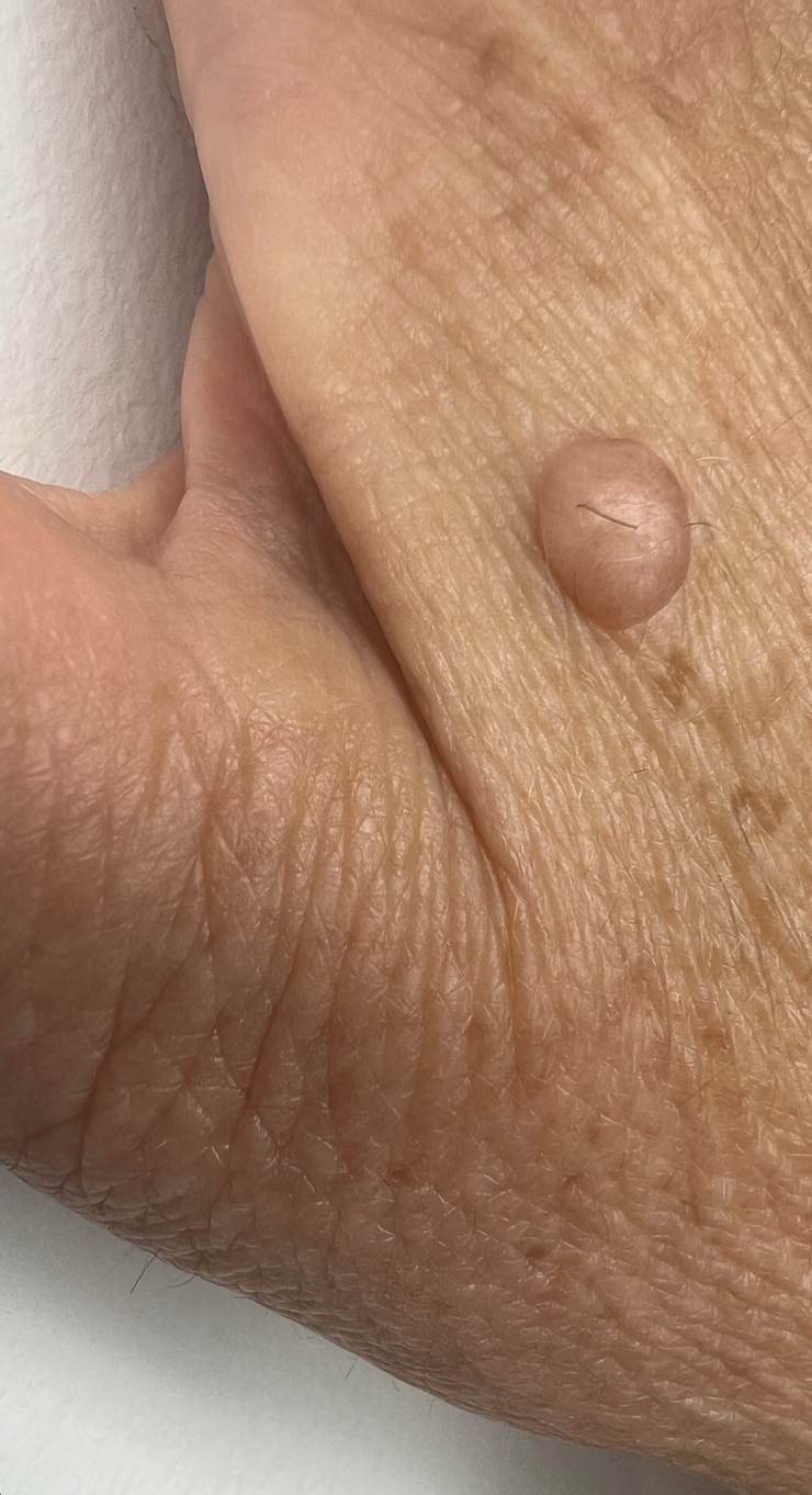 Skin tag removal on the hand before treatment