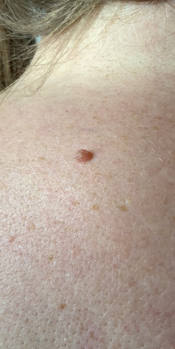 Skin tag removal on the back, before treatment