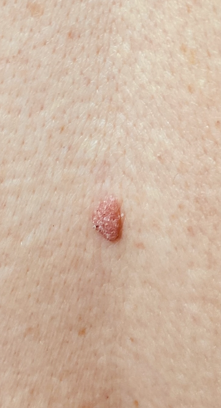 Mole removal before treatment