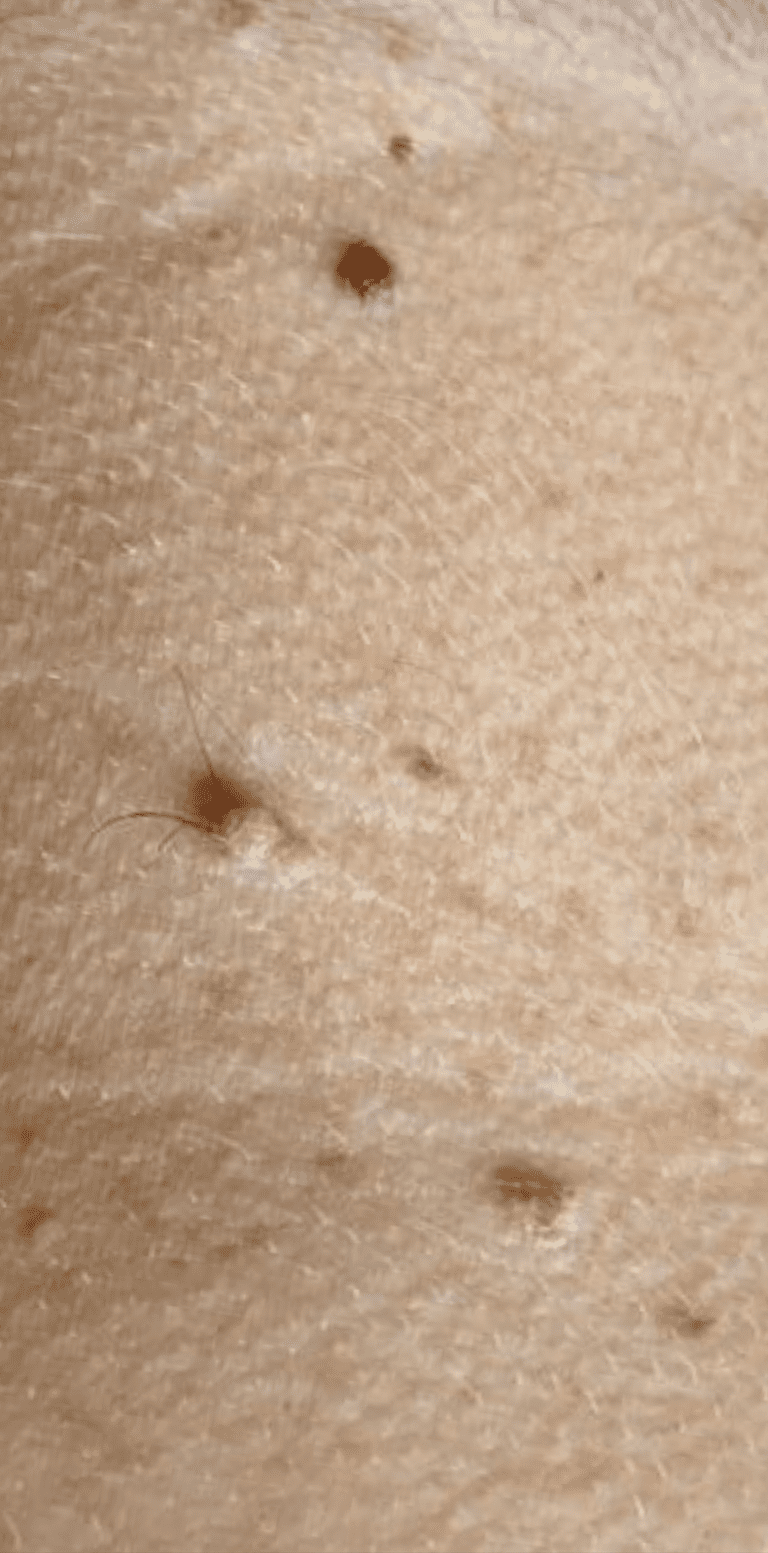 Skin tag removal before and after