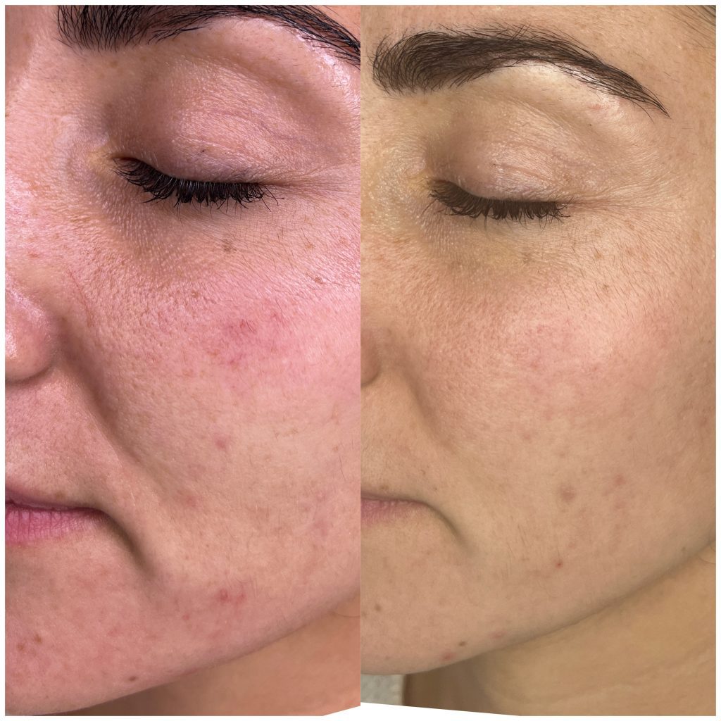 Fractional CO2 Skin Rejuvenation before and after 1