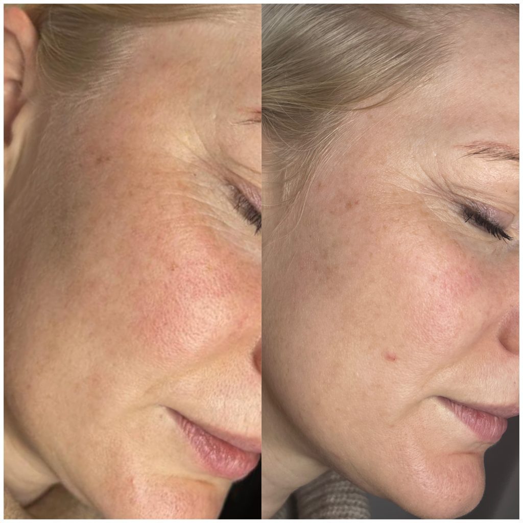 Fractional CO2 Skin Rejuvination before and after 3