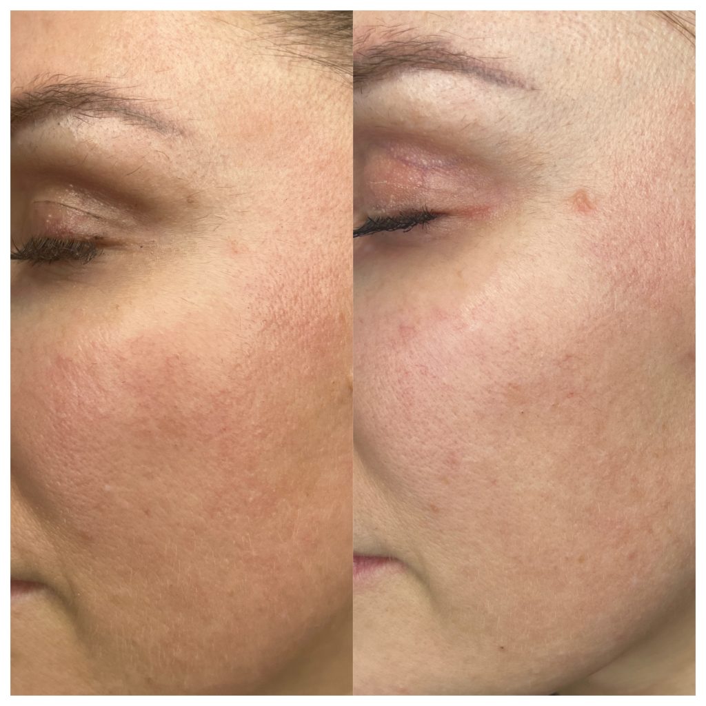 Fractional CO2 facial before and after 2