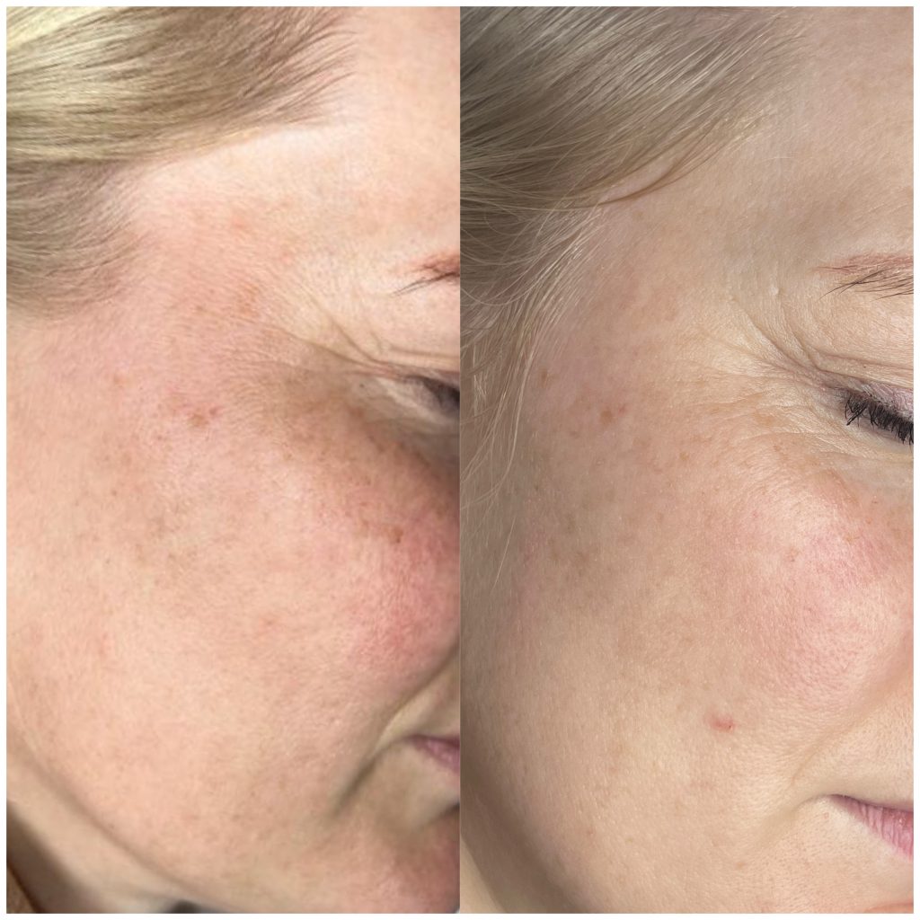Fractional CO2 facial before and after 4