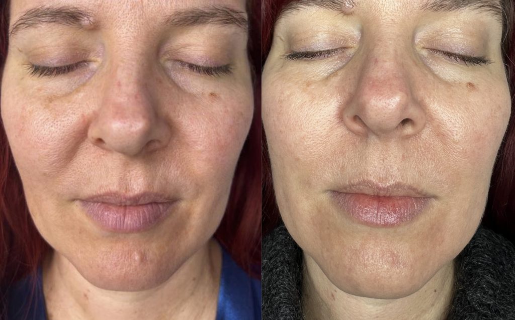 before and after picture of a woman's face who has had a prescription resurfacing facial