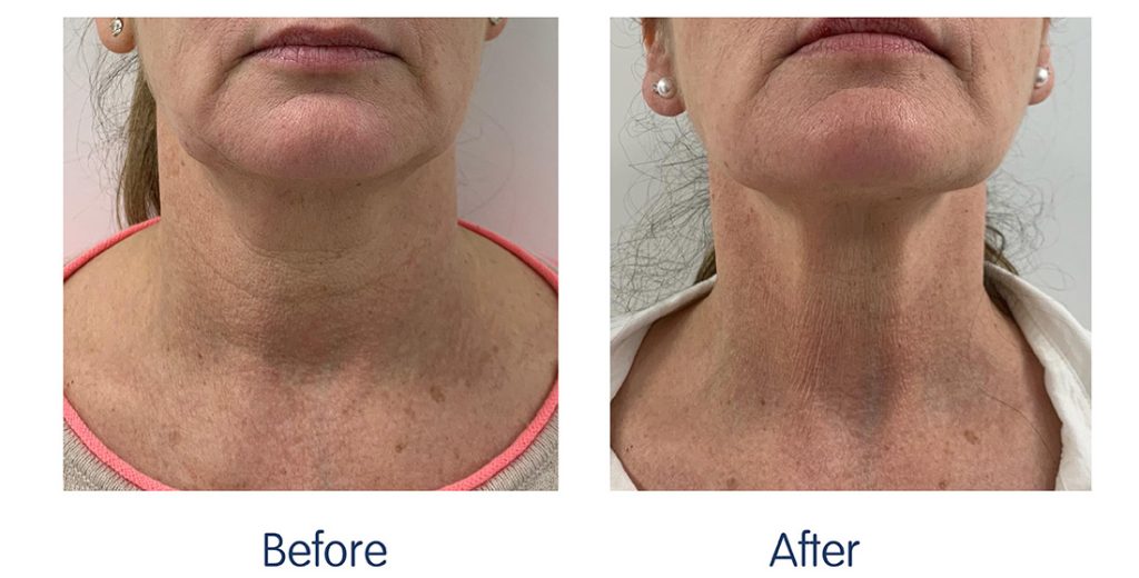 RF Microneedling Before and After 4