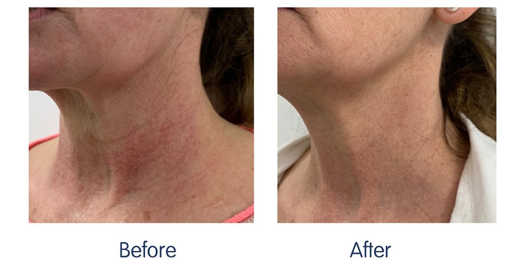RF Microneedling Before and After 5