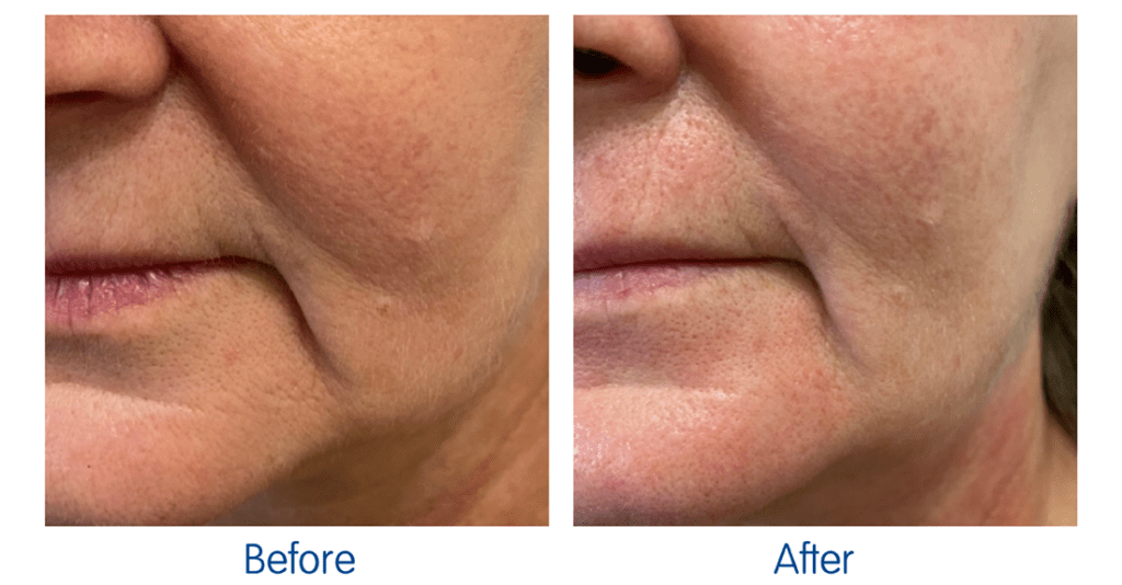 RF Microneedling Before and After 6