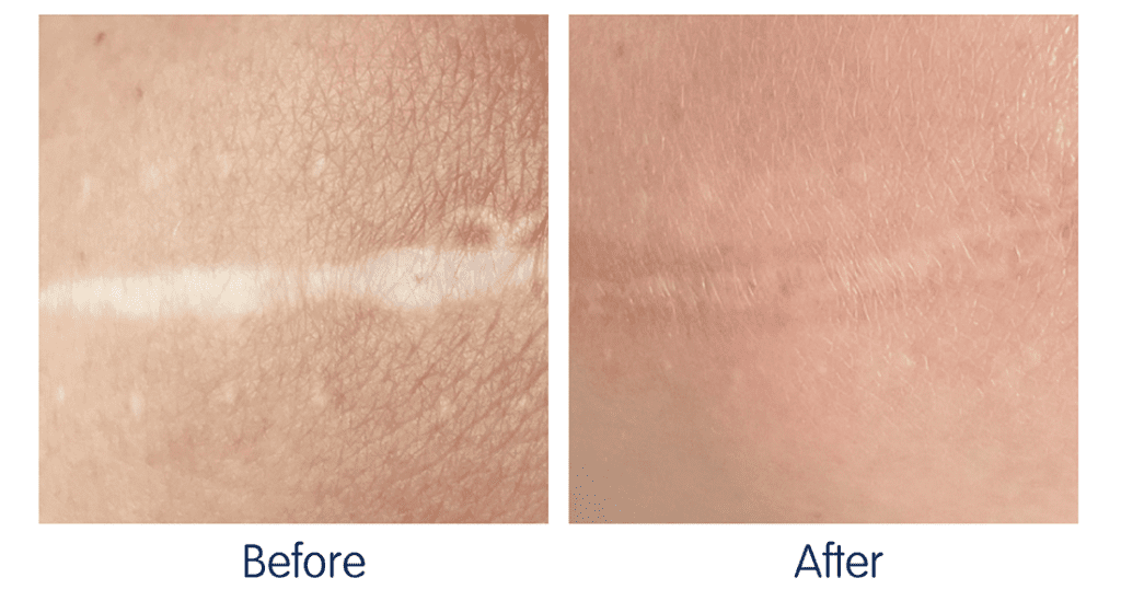 RF Microneedling Before and After 7