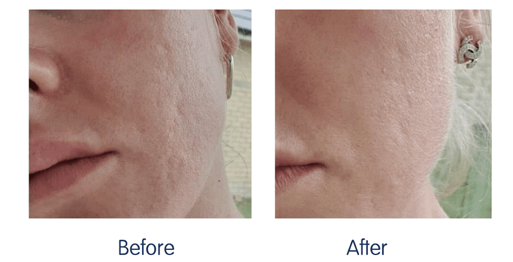 RF Microneedling Before and After 8
