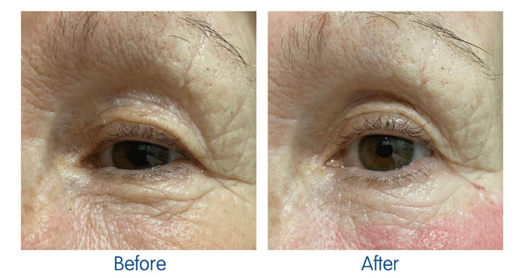 RF Microneedling Before and After 9