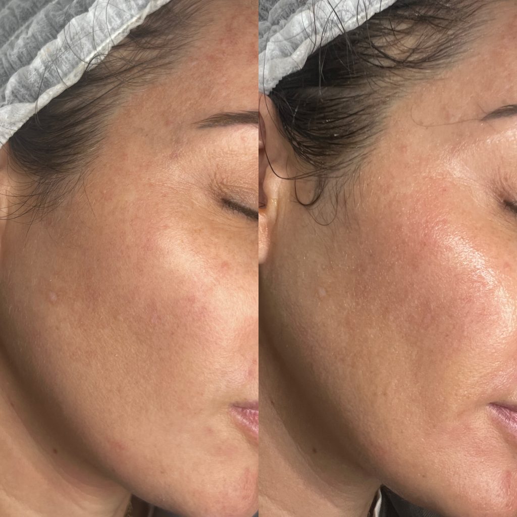 Hydra facial before and after