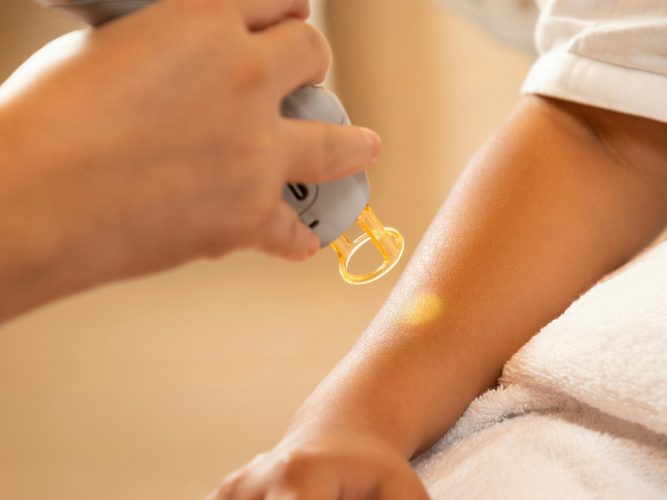 Laser hair removal during menopause
